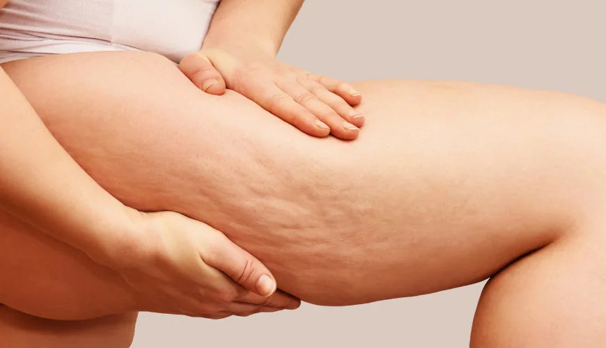 Comprendre la cellulite