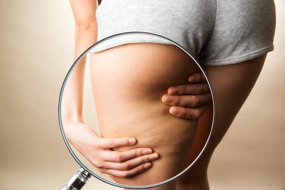 3 Mythes sur la cellulite – Démasqués !